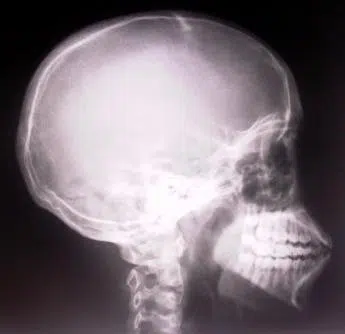 Brain Headinjury