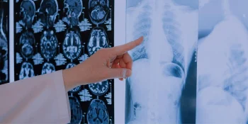 How long should you be sore after a car accident?