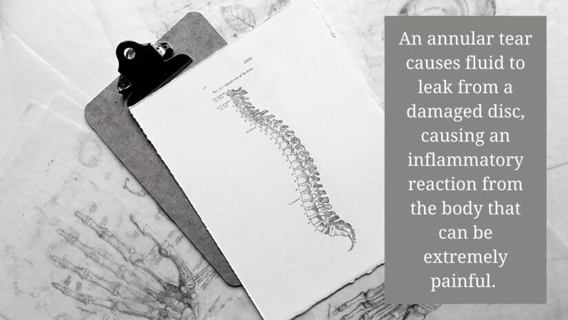 image of discs in spine to show where an annular tear can be